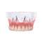 Dental Overdenture Teeth Implant Model Restoration