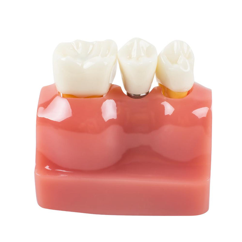 Advanced Dental Study Model with Removable Teeth Model for Implant Analysis, Crown & Bridge Demonstration - Ideal for Dentists