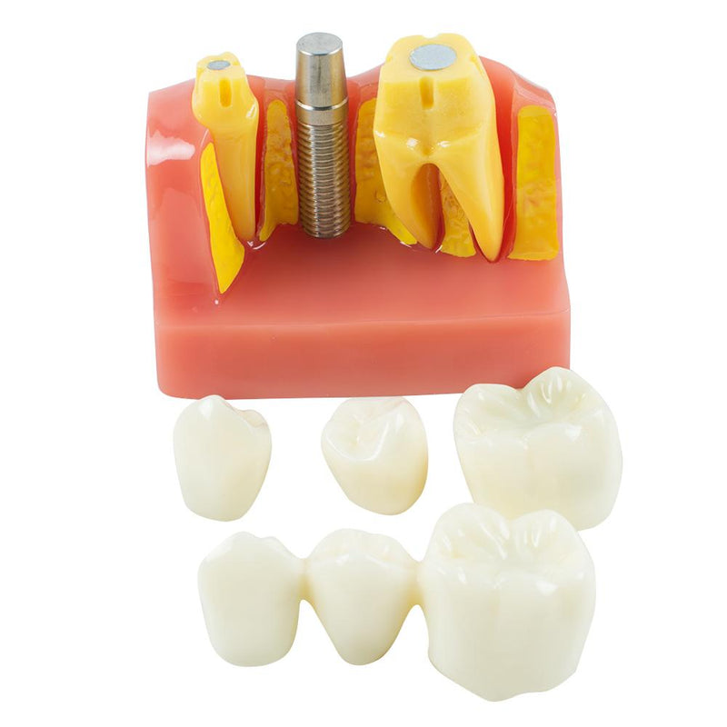 Advanced Dental Study Model with Removable Teeth Model for Implant Analysis, Crown & Bridge Demonstration - Ideal for Dentists