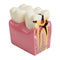 Dental Patient Education Teeth Model 6 Times Caries Comparation Study Model