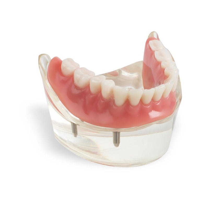 Dental Model Overdenture Inferior 2 Implants Restroration Study
