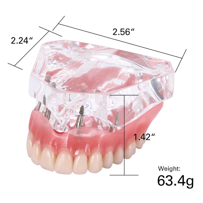 Dental Overdenture Teeth Implant Model Restoration
