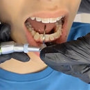 1pcs Dental Orthodontic Polishing Strip Interproximal Teeth Reciprocating Abrasive Metal Enamel Stripping System Handpiece Tool